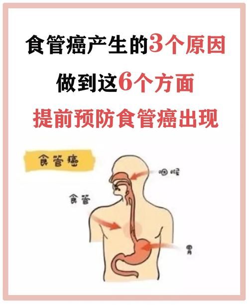 广州金沙洲肿瘤医院张涵英医师分享食管健康保卫战：六招教你远离食道癌威胁