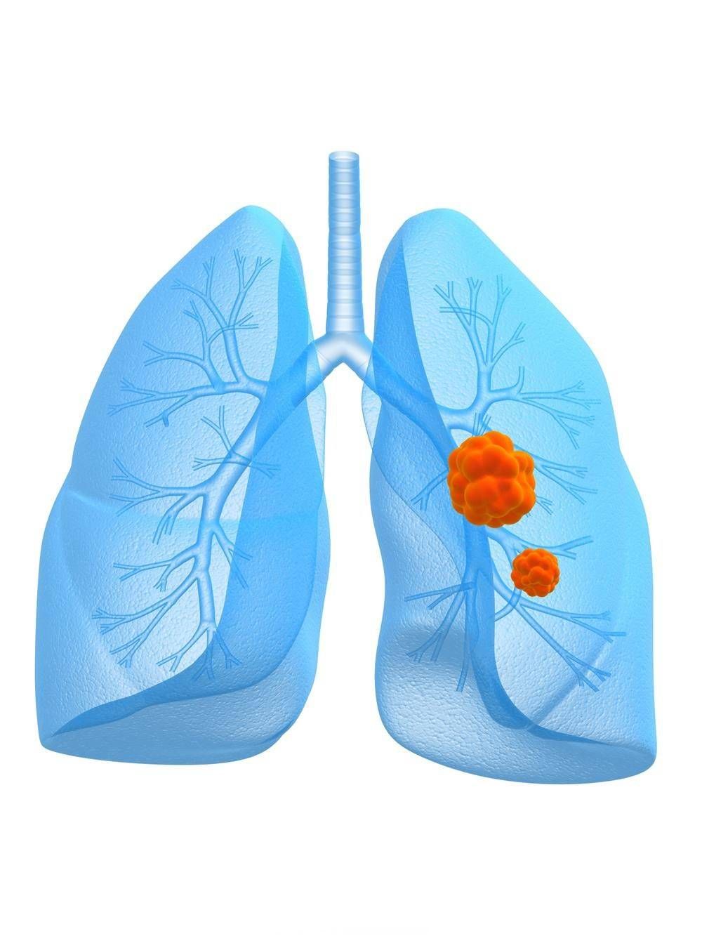 广州金沙洲肿瘤医院马晓东医生提醒：小心肺部“定时炸弹”，肺肿瘤成因大揭秘