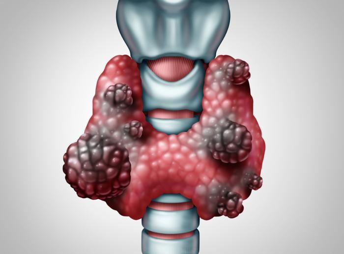 广州中医药大学金沙洲肿瘤医院马晓东医生——甲状腺癌会转移吗？这些关键信息帮你理清