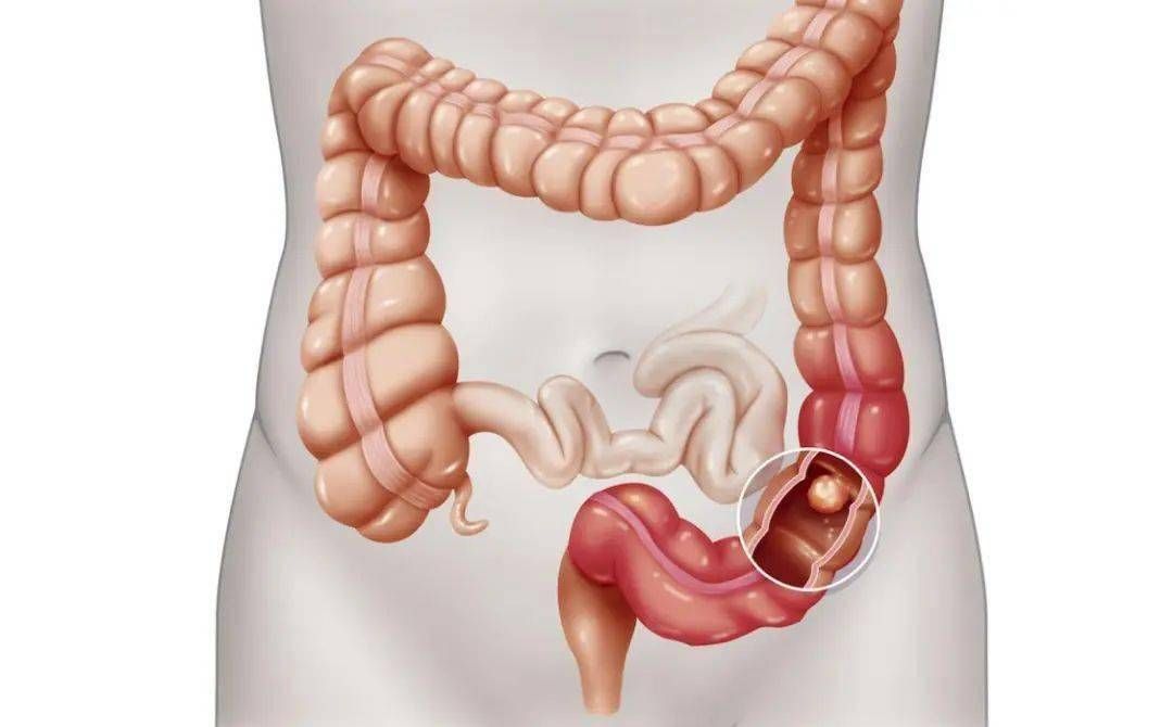 广州中医药大学金沙洲肿瘤医院李坤医生：结肠癌术后饮食指南，科学进食助力身体恢复