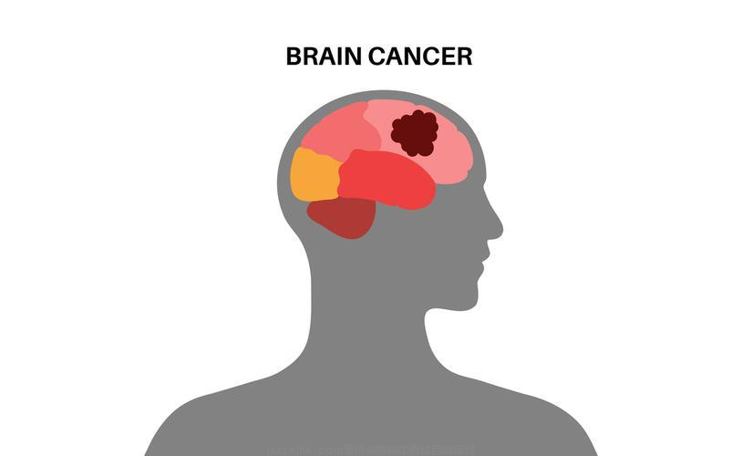 广州中医药大学金沙洲肿瘤医院马晓东医生：警惕！这些可能是脑胶质瘤的早期 “预警信号”