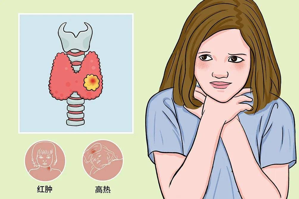 祖力医生提醒甲状腺癌最明显的征兆，早发现早干预是关键