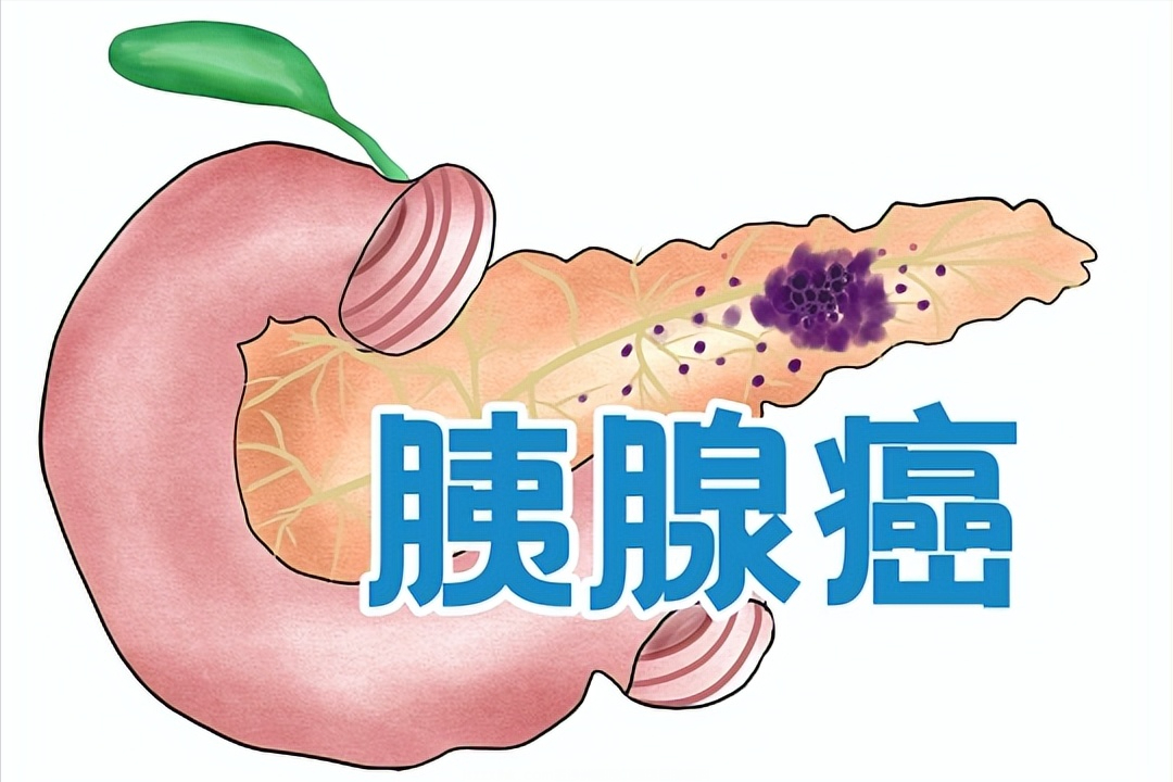 徐肖峰医生提醒胰腺癌发病隐匿，稍有不适应早筛查、早诊断、早治疗提高治愈成功率